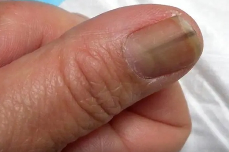 甲乳头状瘤纵行黑带图