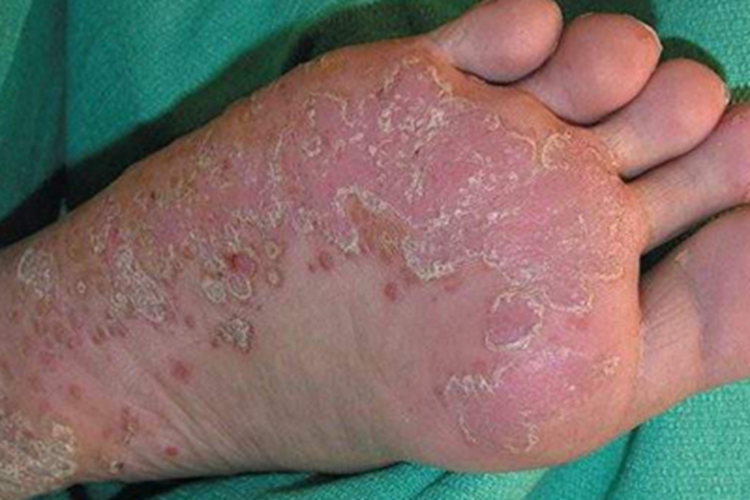 围绝经期角皮症脚底红斑图