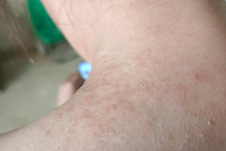 过敏性皮炎肩部症状图