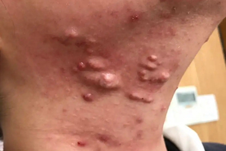 浅表性皮肤脂肪瘤痣脖子起疙瘩图