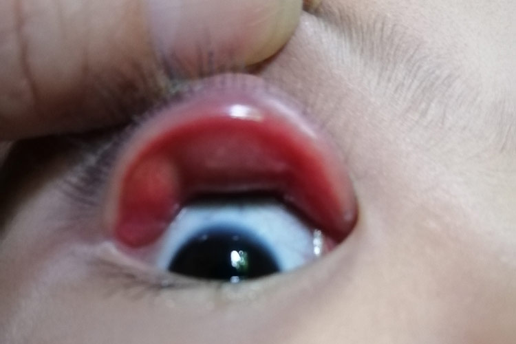 小孩内睑腺炎图