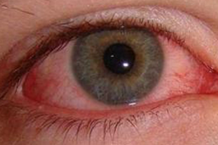 超急性细菌性结膜炎结膜症状图