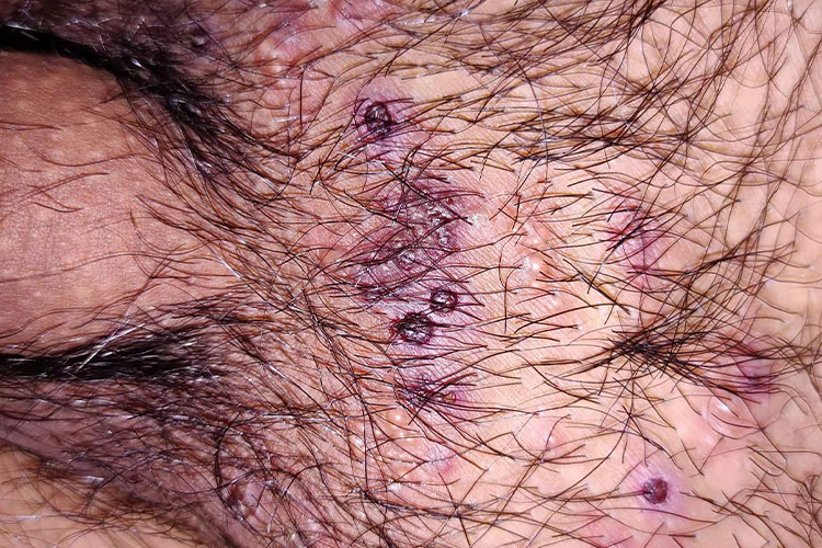 毛囊口红肿图 毛囊口红肿图