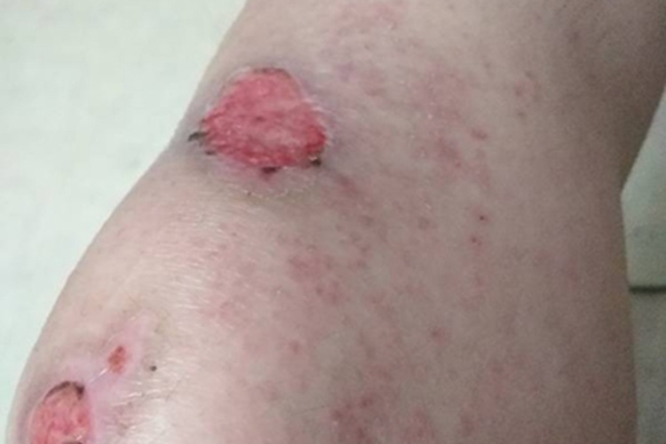 外科型猩红热丘疹图