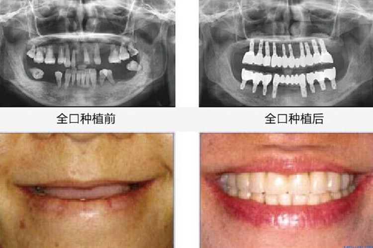 全口种植牙前后效果图