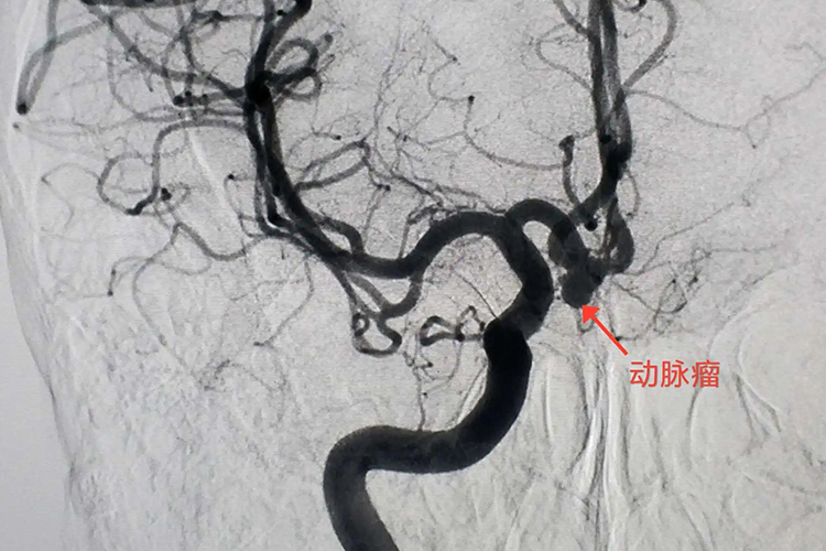 颅内动脉瘤图 颅内动脉瘤图