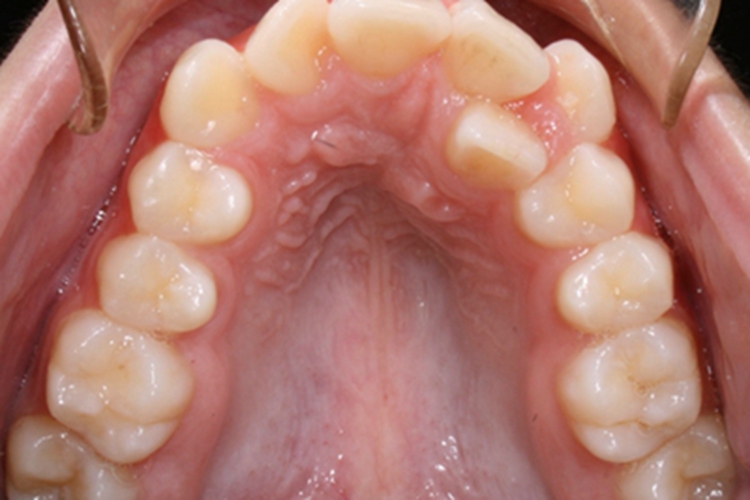 阻生牙牙齿并排生长图 阻生牙牙齿并排生长图