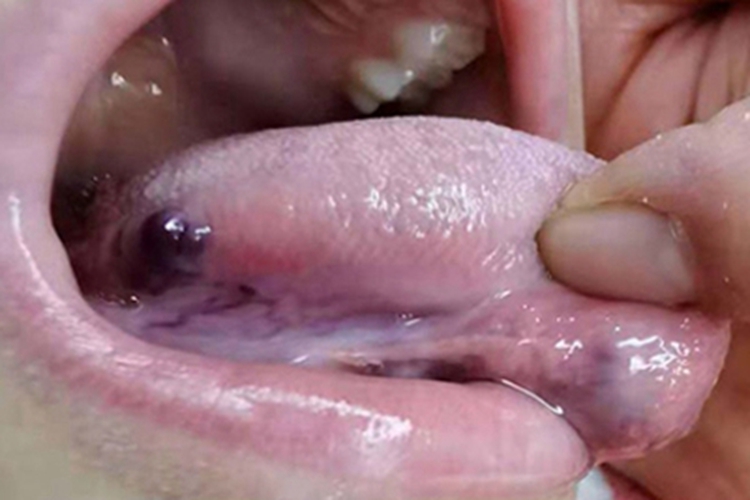 血管瘤舌头症状图