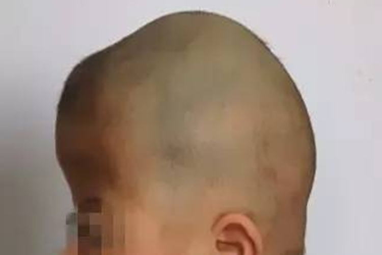 狭颅症短头畸形图