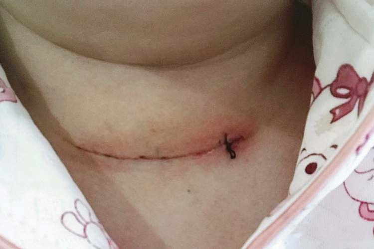 甲状腺乳头状癌手术后伤口图