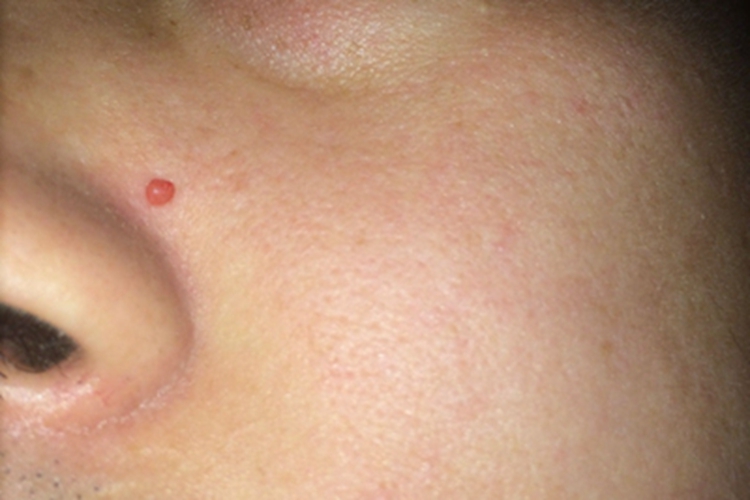 毛囊周围纤维瘤面部结节图