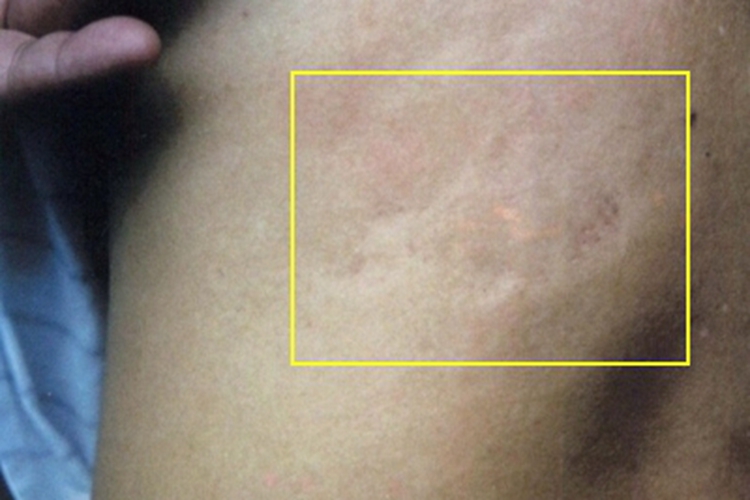 进行性特发性皮肤萎缩背部有坑图