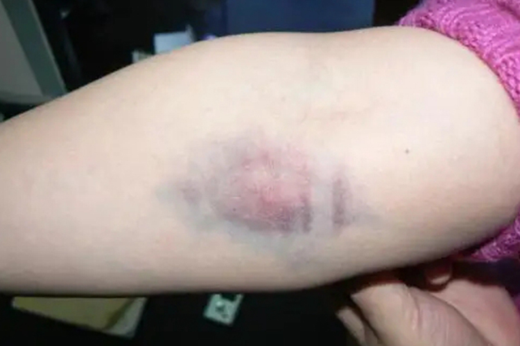 手臂紫癜伴瘀斑图 手臂紫癜伴瘀斑图