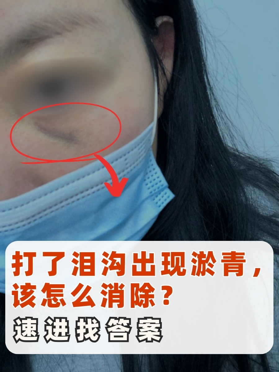 打了泪沟出现淤青,该怎么消除?速进找答案