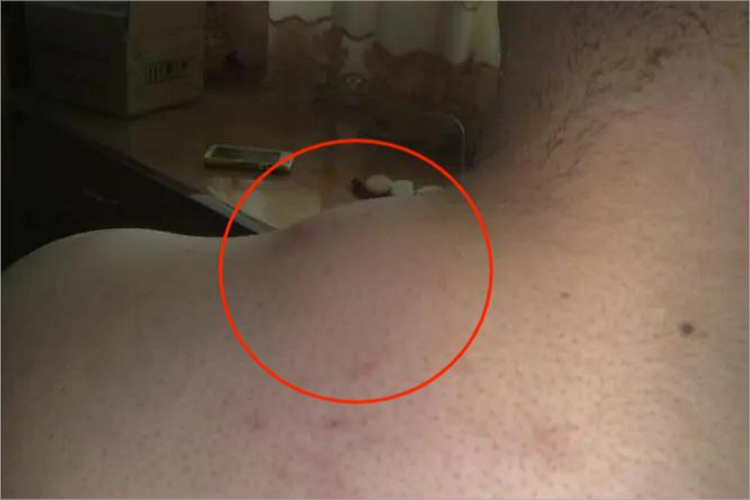 血管外皮细胞瘤肩部症状图