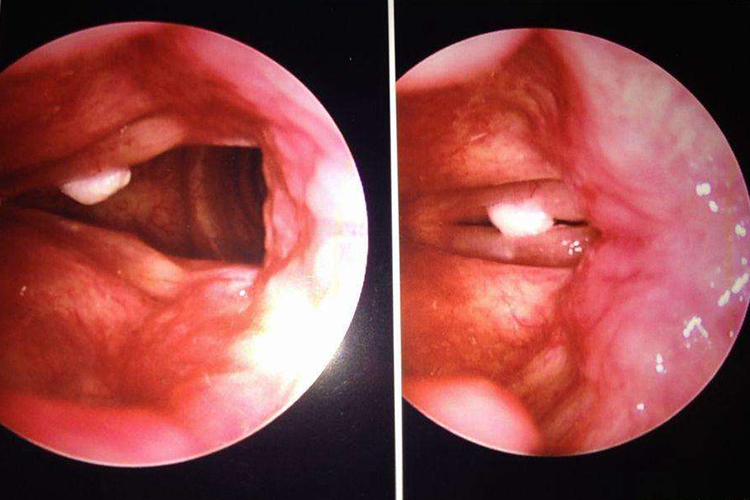 喉淀粉样变图 喉淀粉样变图