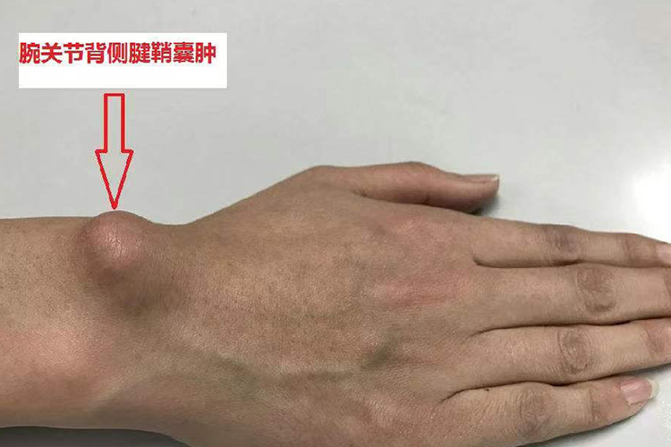 桡骨茎突狭窄性腱鞘炎图