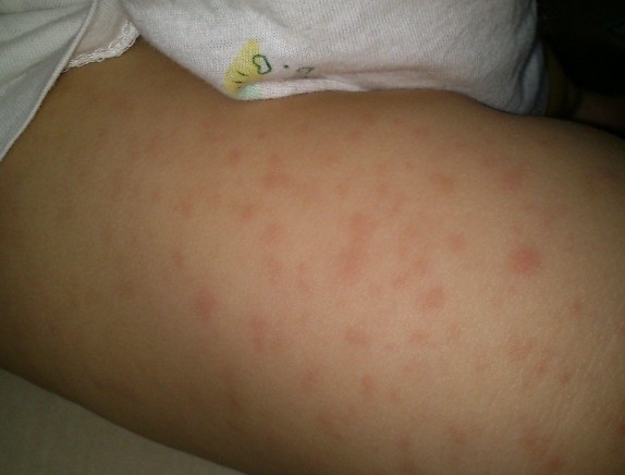 儿童风疹的症状用中药外洗的图片