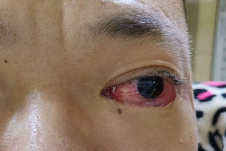 眶蜂窝织炎眼球充血图 眶蜂窝织炎眼球充血图