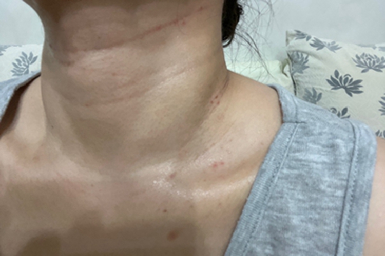 毛囊炎侧颈上几个红点点图 毛囊炎侧颈上几个红点点图