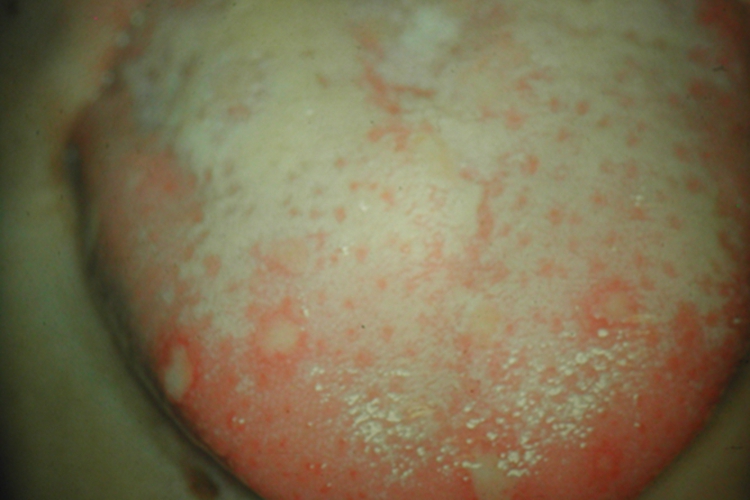 手足口病舌头红点图