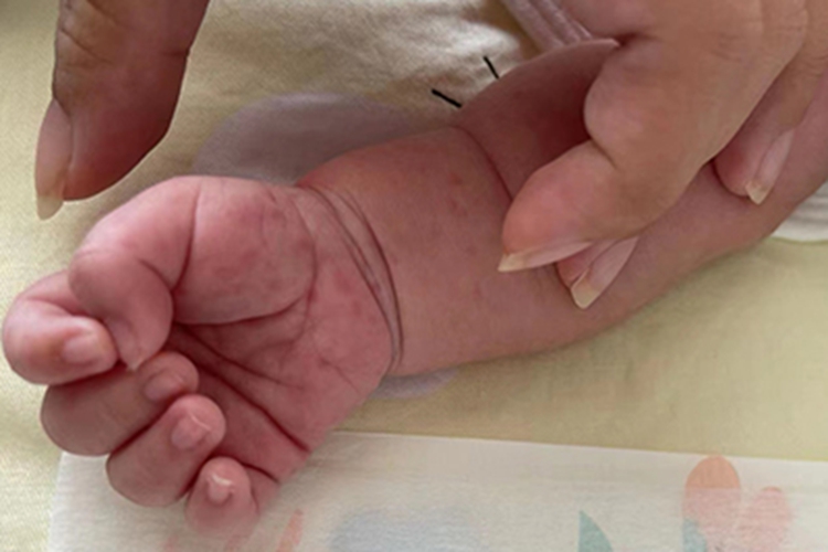 手足口病手部小疙瘩图 手足口病手部小疙瘩图