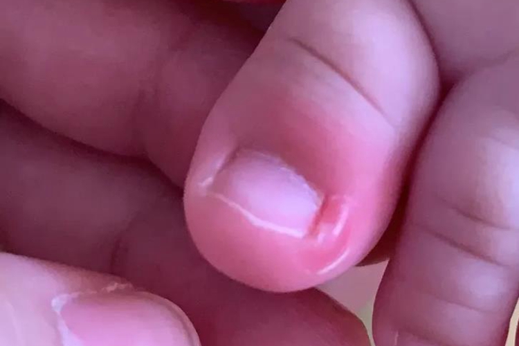 三个月宝宝甲沟炎甲周红肿图 三个月宝宝甲沟炎甲周红肿图