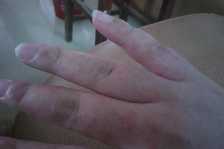 粉笔过敏手指红斑丘疹图