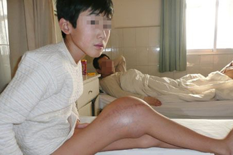 腿部膝关节骨肉瘤图