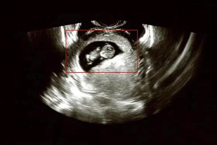 怀孕67天胎儿超声图