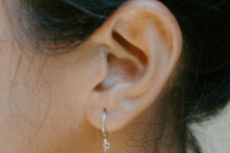 杯状耳轻度症状图