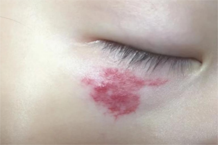 蔓状血管瘤脸上有一片红斑图