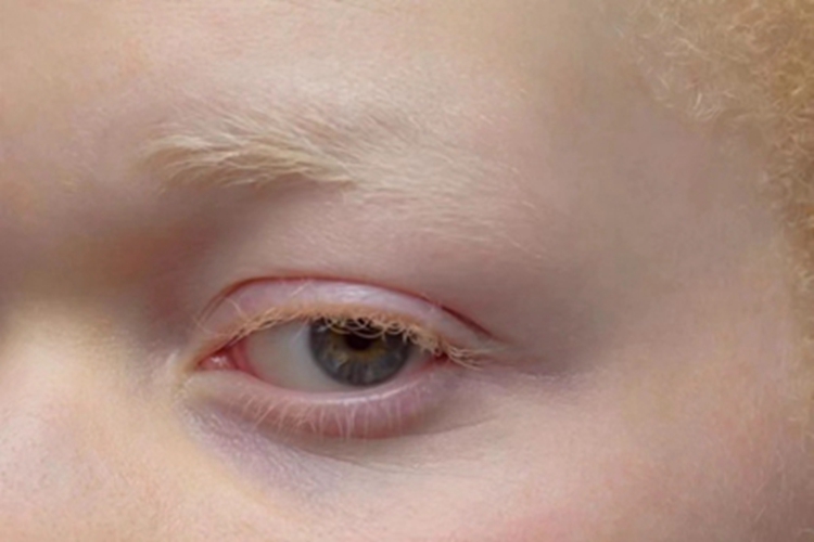 眼皮肤白化病症状图