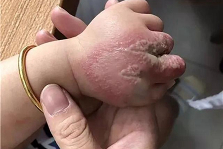 昆虫性皮炎手背肿图