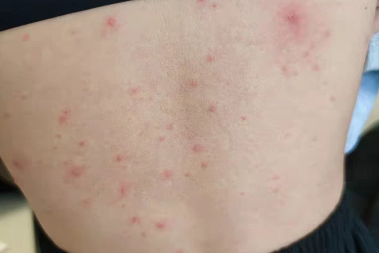 水痘红色丘疹图