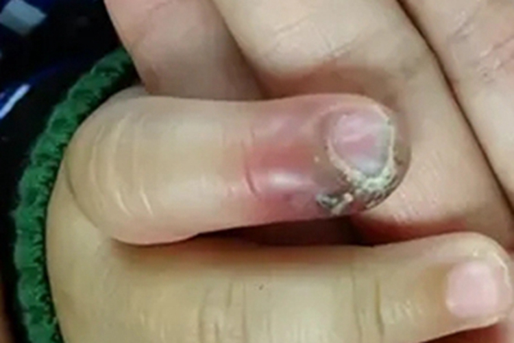 慢性甲沟炎手指症状图