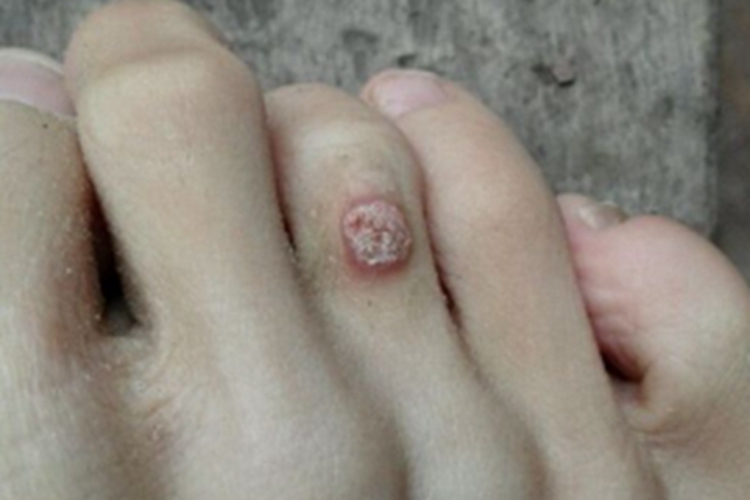 职业性疣赘脚趾症状图