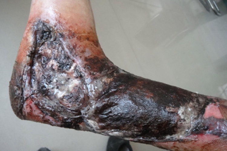 血栓闭塞性脉管炎小腿坏疽图 血栓闭塞性脉管炎小腿坏疽图