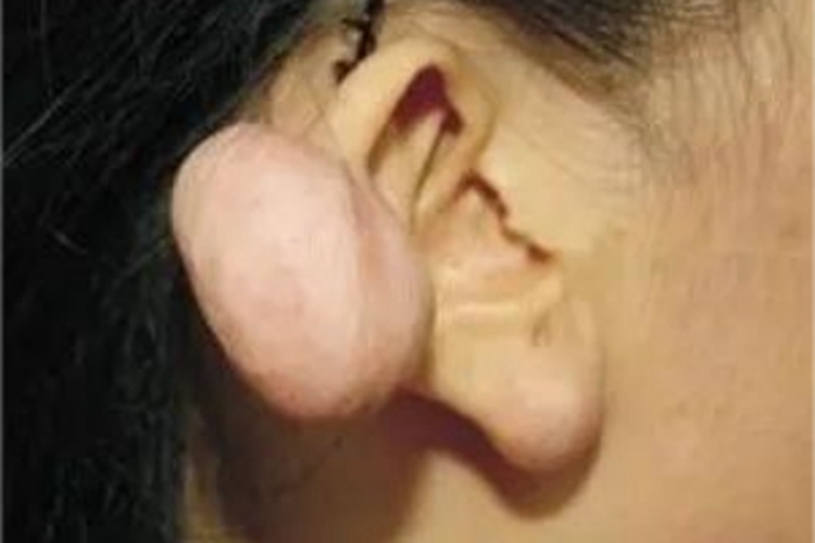 副耳耳廓大疙瘩图