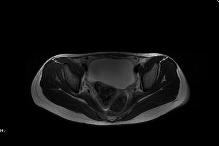 附件炎伴盆腔积液图 附件炎伴盆腔积液图