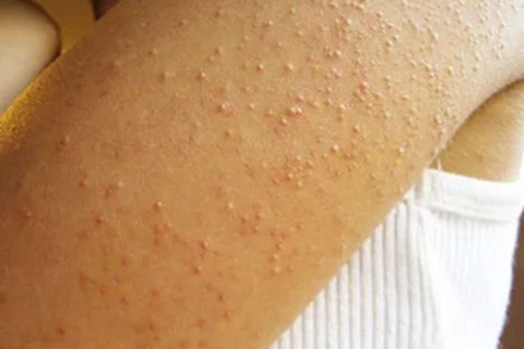 毛囊角化病胳膊皮肤粗糙图