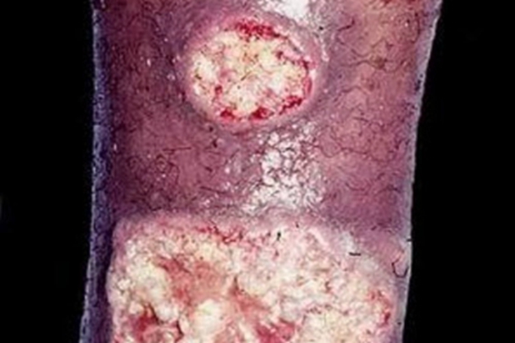 皮肤利什曼病小腿症状图