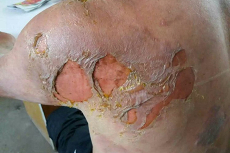 二度烫伤后背脱皮图