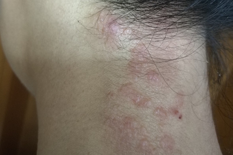 花斑癣颈部白色癣图