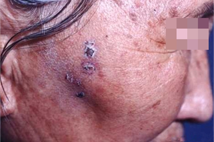 汗孔角化病面部结黑痂图