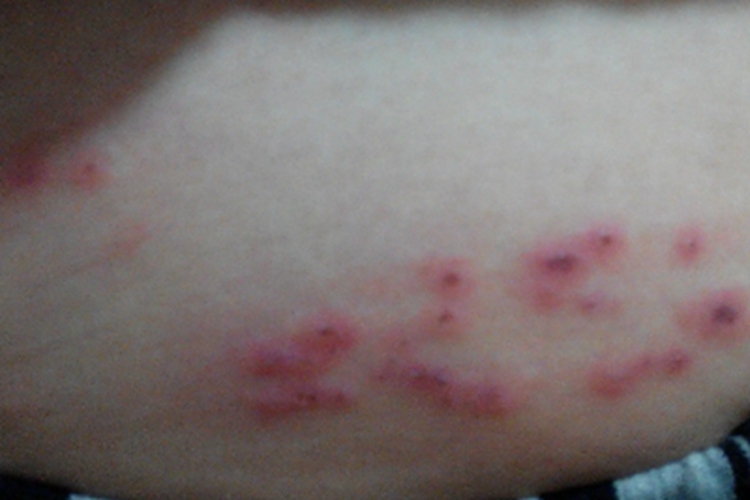 淋巴瘤样丘疹病腹部结痂图