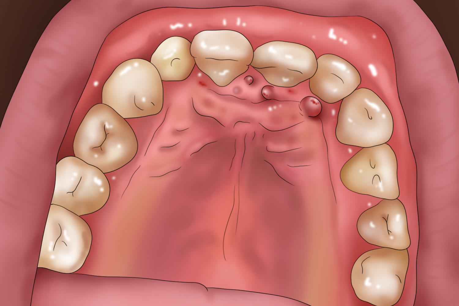 口腔上颚根尖肉芽肿图