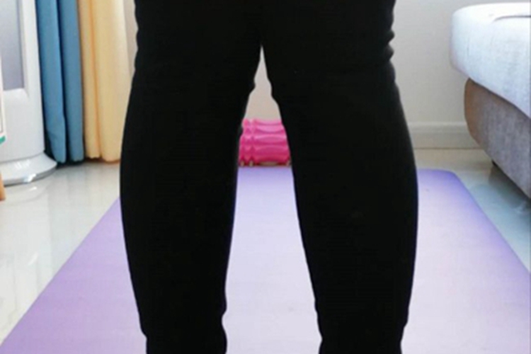 病理性膝外翻症状图 病理性膝外翻症状图