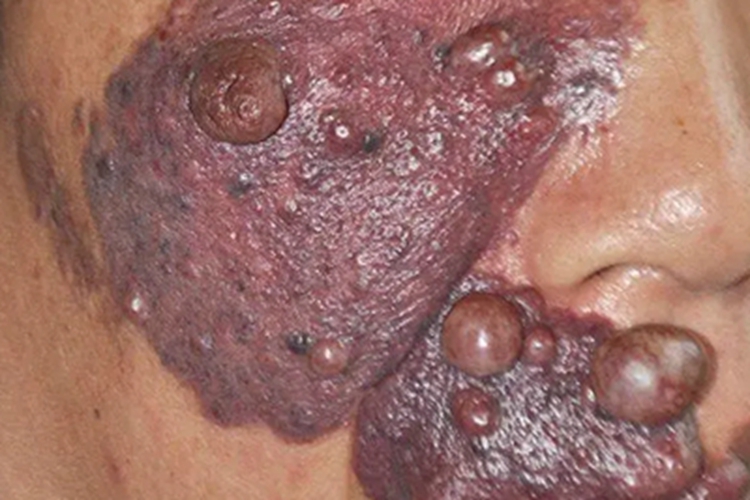 鲜红斑痣面部症状图