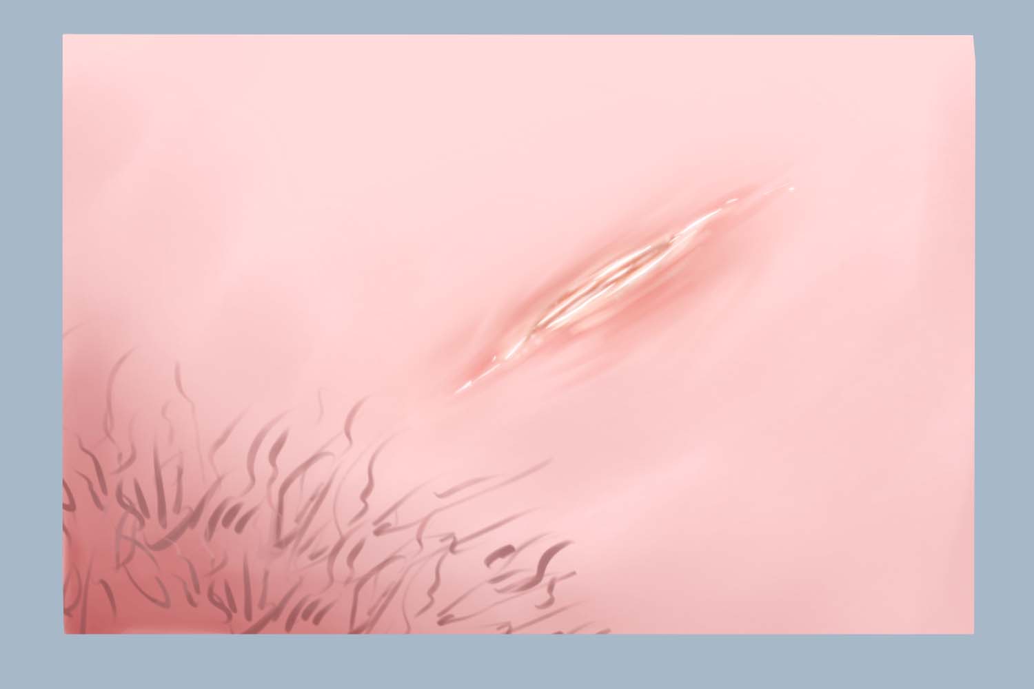 精索静脉曲张术后一年疤痕图